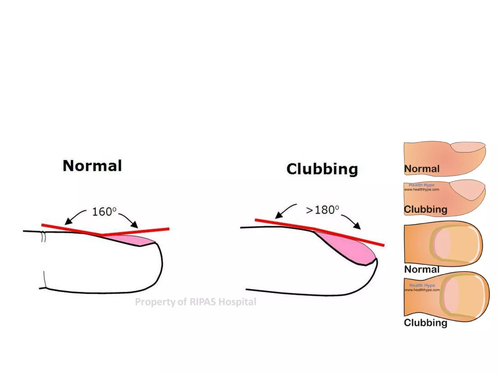 Clubbing PPT Clubbing PPT