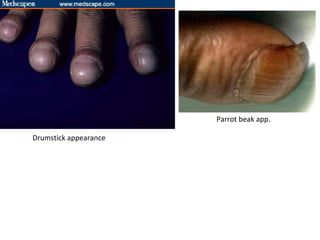 Clubbing | PPT