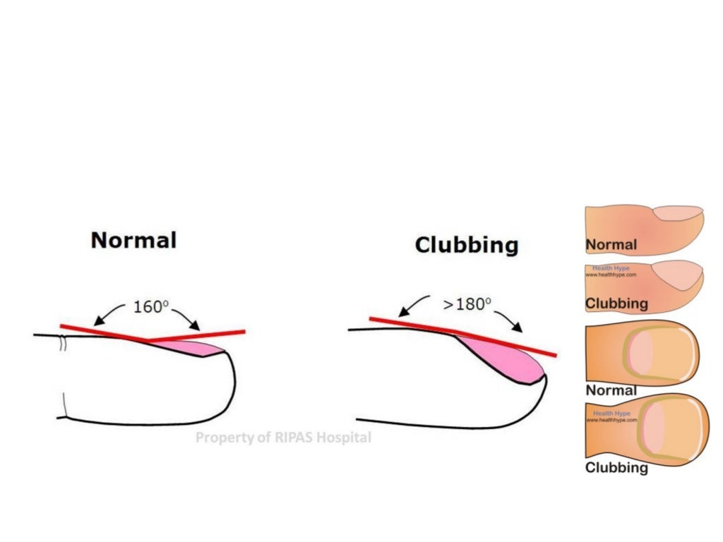 Clubbing clubbing