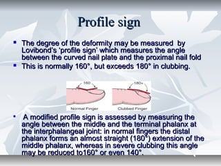 Profile signProfile sign
 The degree of the deformity may be measured byThe degree of the deformity may be measured by
Lovibond’s ‘profile sign’ which measures the angleLovibond’s ‘profile sign’ which measures the angle
between the curved nail plate and the proximal nail foldbetween the curved nail plate and the proximal nail fold
 This is normally 160°, but exceeds 180° in clubbing.This is normally 160°, but exceeds 180° in clubbing.

A modified profile sign is assessed by measuring theA modified profile sign is assessed by measuring the
angle between the middle and the terminal phalanx atangle between the middle and the terminal phalanx at
the interphalangeal joint: in normal fingers the distalthe interphalangeal joint: in normal fingers the distal
phalanx forms an almost straight (180°) extension of thephalanx forms an almost straight (180°) extension of the
middle phalanx, whereas in severe clubbing this anglemiddle phalanx, whereas in severe clubbing this angle
may be reduced to160° or even 140°.may be reduced to160° or even 140°.
 