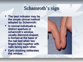 Schamroth’s signSchamroth’s sign
 The best indicator may beThe best indicator may be
the simple clinical methodthe simple clinical method
adopted by Schamroth:adopted by Schamroth:
 In normal individuals aIn normal individuals a
distinct aperture ordistinct aperture or
schamroth’s window,schamroth’s window,
usually diamond-shaped,usually diamond-shaped,
is formed at the base ofis formed at the base of
the nail bed when twothe nail bed when two
fingers held together withfingers held together with
nails facing each other.nails facing each other.
 Early clubbing obliteratesEarly clubbing obliterates
this window.this window.
 