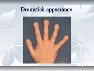 Drumstick appearanceDrumstick appearance
 