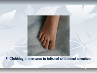  Clubbing in toes seen in infected abdominal aneurismClubbing in toes seen in infected abdominal aneurism
 
