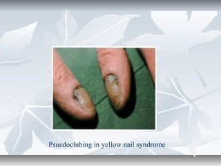Psuedoclubing in yellow nail syndrome
 
