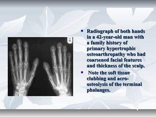  Radiograph of both handsRadiograph of both hands
in a 42-year-old man within a 42-year-old man with
a family history ofa family history of
primary hypertrophicprimary hypertrophic
osteoarthropathy who hadosteoarthropathy who had
coarsened facial featurescoarsened facial features
and thickness of the scalp.and thickness of the scalp.
 Note the soft tissueNote the soft tissue
clubbing and acro-clubbing and acro-
osteolysis of the terminalosteolysis of the terminal
phalanges.phalanges.
 