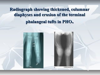 Radiograph showing thickened, columnarRadiograph showing thickened, columnar
diaphyses and erosion of the terminaldiaphyses and erosion of the terminal
phalangeal tufts in PHOphalangeal tufts in PHO..
 