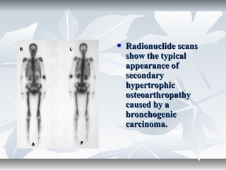  Radionuclide scansRadionuclide scans
show the typicalshow the typical
appearance ofappearance of
secondarysecondary
hypertrophichypertrophic
osteoarthropathyosteoarthropathy
caused by acaused by a
bronchogenicbronchogenic
carcinoma.carcinoma.
 