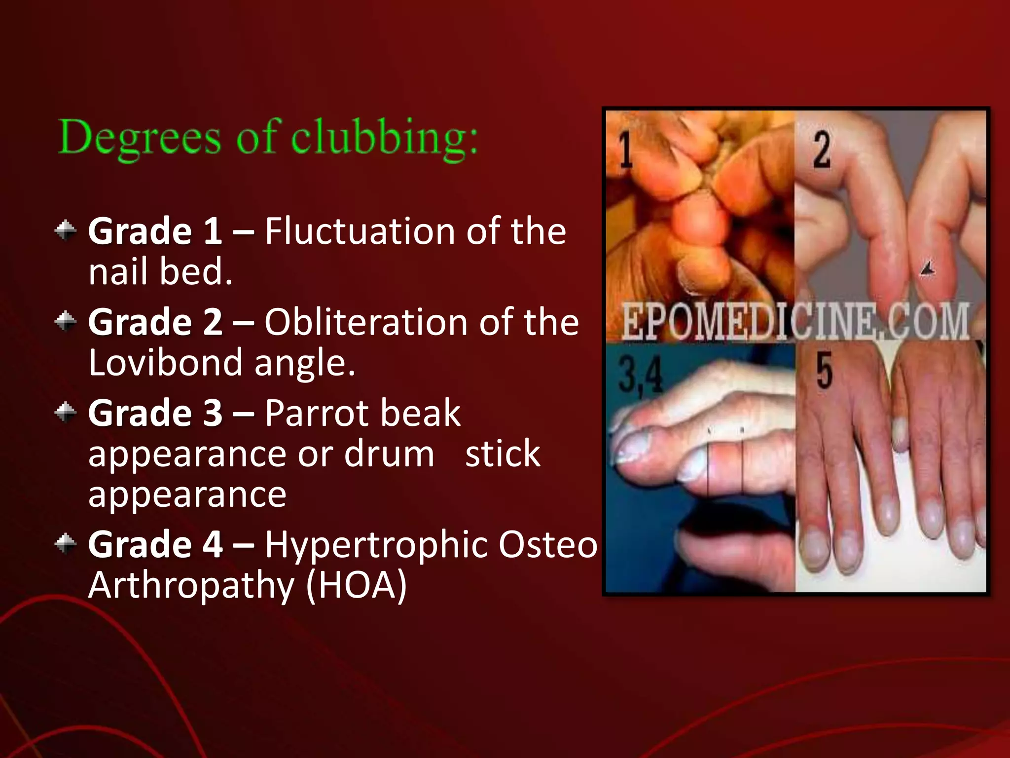 Nail Clubbing Algorithm Clubbing | PPTX