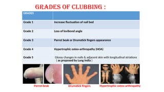 Nail Clubbing Algorithm CLUBBING.pptx by Dr. Shakil Ali Dewan. smmhmc | PPTX