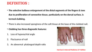 Nail Clubbing Algorithm CLUBBING.pptx by Dr. Shakil Ali Dewan. smmhmc | PPTX