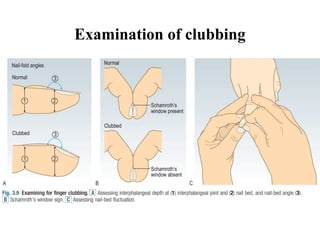 Nail Clubbing Algorithm Approach to Clubbing (differential diagnosis, grading, mechanism ...