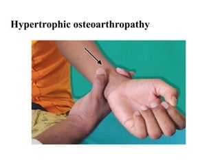 Approach to Clubbing (differential diagnosis, grading, mechanism ...