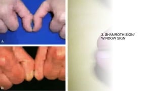 Witchott Sign clubbing ppt.pptx. definition, clinical signs, grades. Causes | PPTX