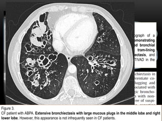 Fibrosis Quistica | PPTX