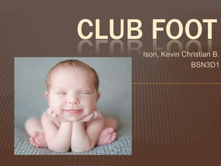 CLUB FOOT
    Ison, Kevin Christian B.
                  BSN3D1
 