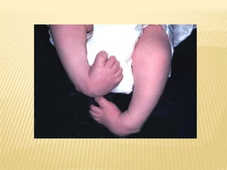 Club Foot Club Foot