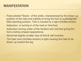 Club Foot Club Foot