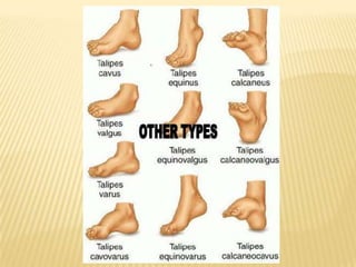 Club Foot Club Foot