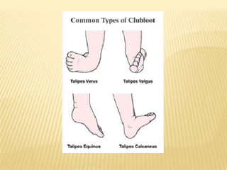 Club Foot Club Foot