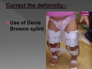 Clubfoot Splint Pattern Club foot | PDF