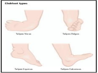 Club Foot