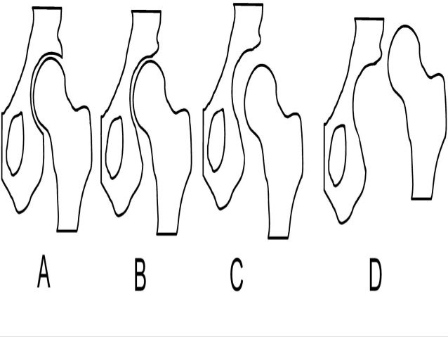 Club Foot