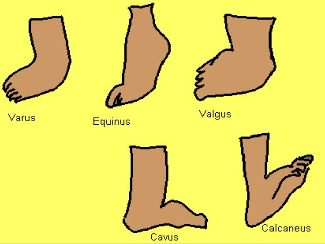 Club Foot