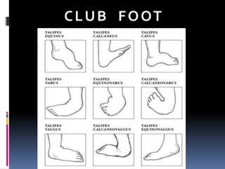 Club Foot