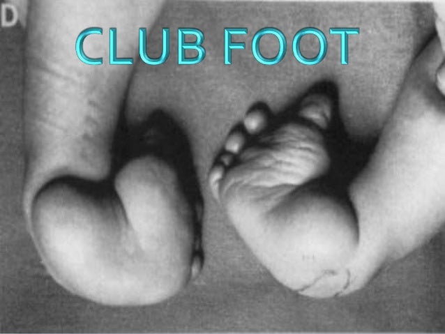 Club Foot Club Foot