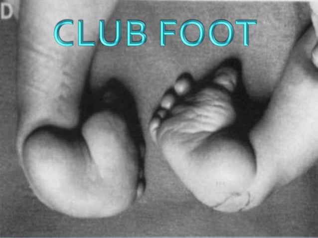 Club Foot