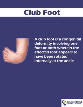Club Foot