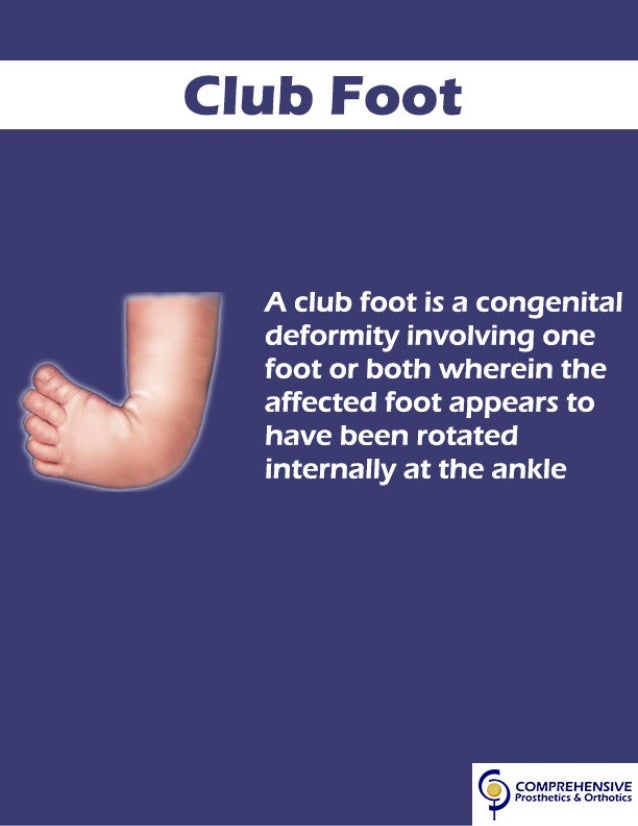 Club Foot Club Foot