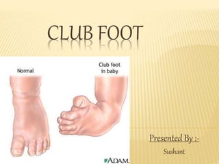 CLUB FOOT
Presented By :-
Sushant
 