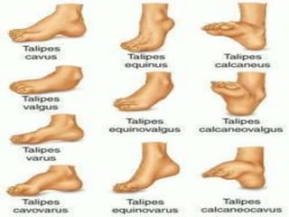 Club Foot Club Foot