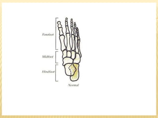 Club Foot Club Foot