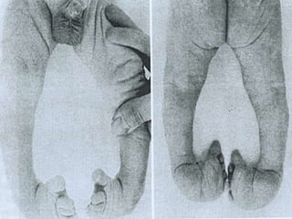Club Foot Club Foot