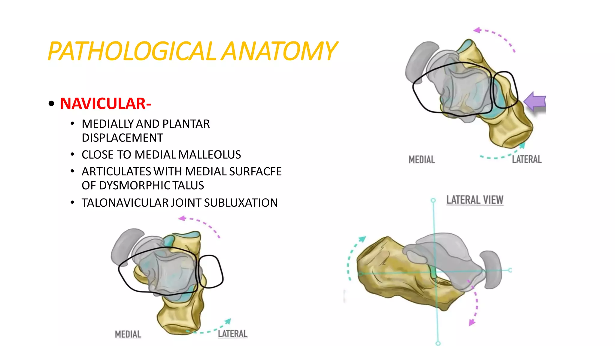 Club foot / CTEV | PDF