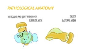 Ctev Types Club foot / CTEV | PDF