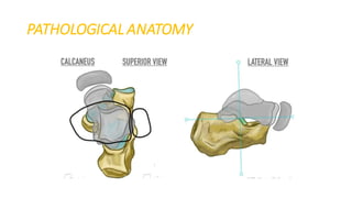 Ctev Types Club foot / CTEV | PDF