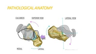 Ctev Types Club foot / CTEV | PDF