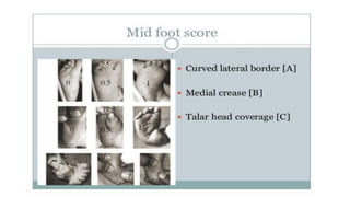Ctev Types Club foot / CTEV | PDF