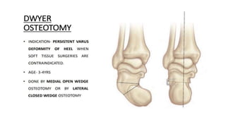 Ctev Types Club foot / CTEV | PDF