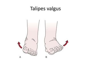 Club Foot