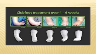 Clubfoot | PPTX