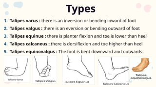 club foot in children .pptx