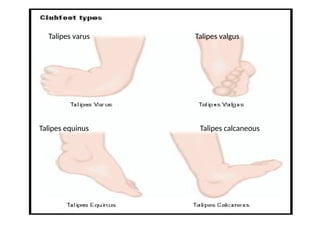 club foot in children, by Dr. Sapna Singh, Professor, Teerthanker ...