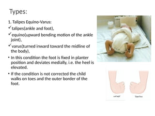club foot in children, by Dr. Sapna Singh, Professor, Teerthanker ...