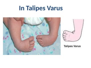 Semester 6 Unit 2 Club foot (talipes).pptx