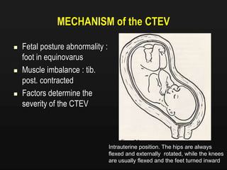 MECHANISM of the CTEV
 Fetal posture abnormality :
foot in equinovarus
 Muscle imbalance : tib.
post. contracted
 Factors determine the
severity of the CTEV
Intrauterine position. The hips are always
flexed and externally rotated, while the knees
are usually flexed and the feet turned inward
 