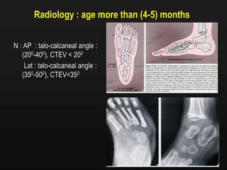 Radiology : age more than (4-5) months
N : AP : talo-calcaneal angle :
(200-400), CTEV < 200
Lat : talo-calcaneal angle :
(350-500), CTEV<350
 